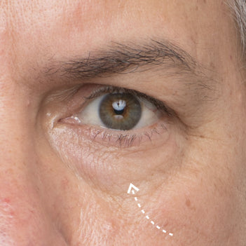 Close up photo of a man's undereye and eye area with an arrow pointing to eye bags and puffiness.