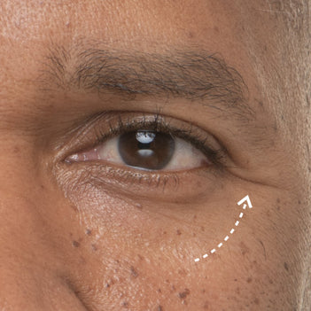 Close up photo of a man's undereye and eye area with an arrow pointing to his fine lines and wrinkles.