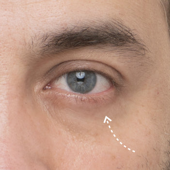 Close up photo of a man's undereye and eye area with an arrow pointing to his dark undereye circles.